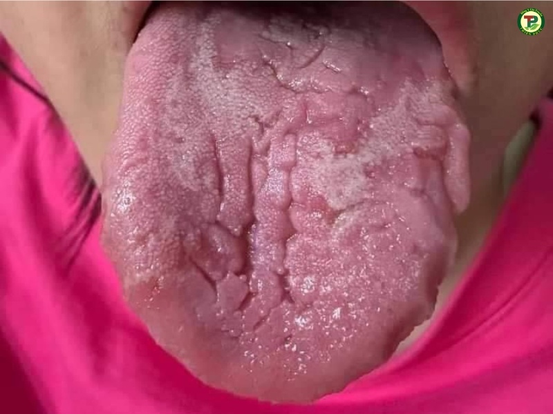 Lưỡi bị nấm và khuẩn tấn công làm phá vỡ cấu trúc lưỡi gây ra nứt lưỡi